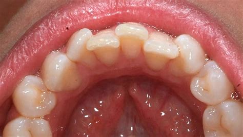 invisalign silkeborg|Tandregulering – Få det flotteste smil med en usynlig tandbøjle.
